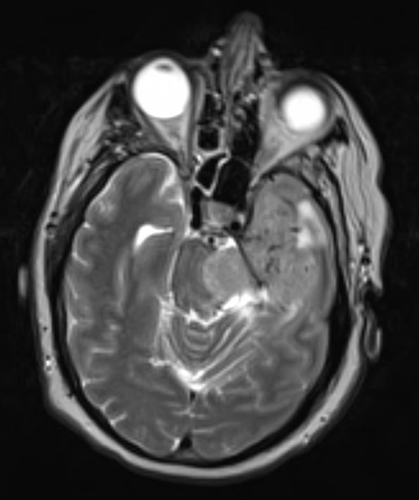 14A2 Hemangiopericytoma, anaplastic (Case 14) T2 3 - Copy