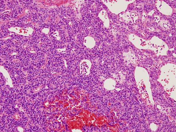 14B1 Hemangiopericytoma, anaplastic (Case 14) H&E 2