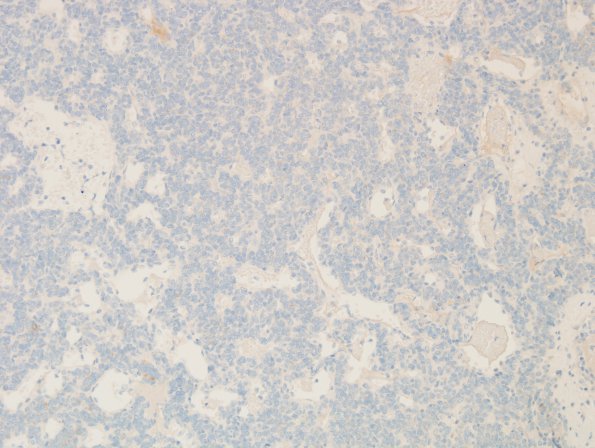 14C Hemangiopericytoma, anaplastic (Case 14) EMA