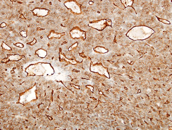 14D1 Hemangiopericytoma, anaplastic (Case 14) CD34 1