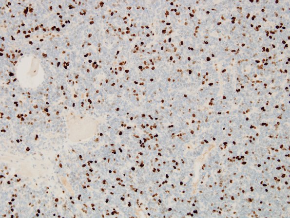 14F Hemangiopericytoma, anaplastic (Case 14) MIB 2