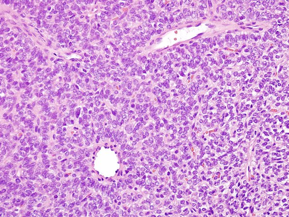 14G1 2nd resection Hemangiopericytoma, metastatic (Case 14) H&E 1.jpg