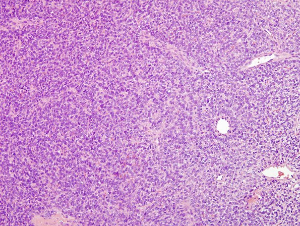 14G2 2nd resection Hemangiopericytoma, metastatic (Case 14) H&E 3.jpg