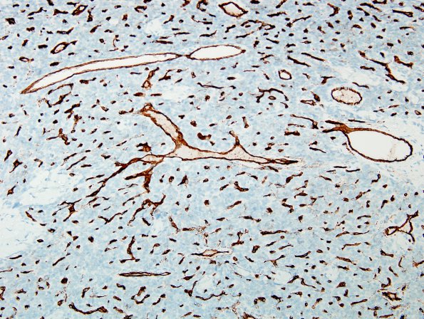 14H1 2nd resection Hemangiopericytoma, metastatic (Case 14) CD34 3.jpg