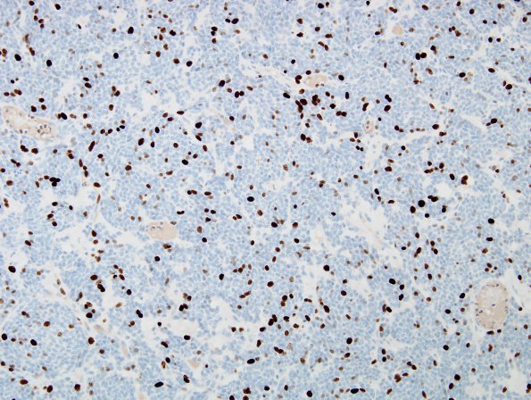 15D Hemangiopericytoma, Gr III (Case 15) MIB 3