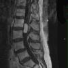 15G1 Hemangiopericytoma, Grade III (Case 15) T1 W - Copy