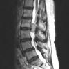 15G2 Hemangiopericytoma, Grade III (Case 15) T2 RESTORE - Copy