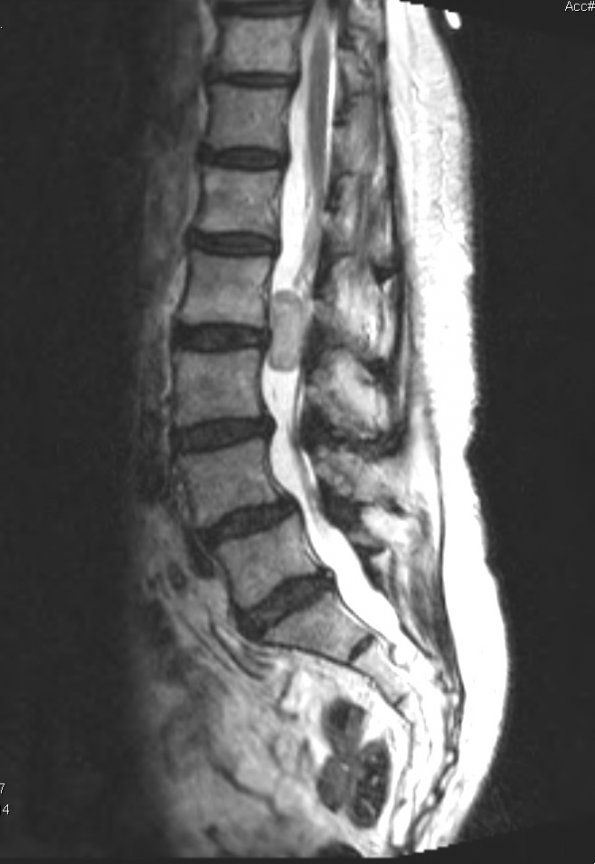 15G2 Hemangiopericytoma, Grade III (Case 15) T2 RESTORE - Copy