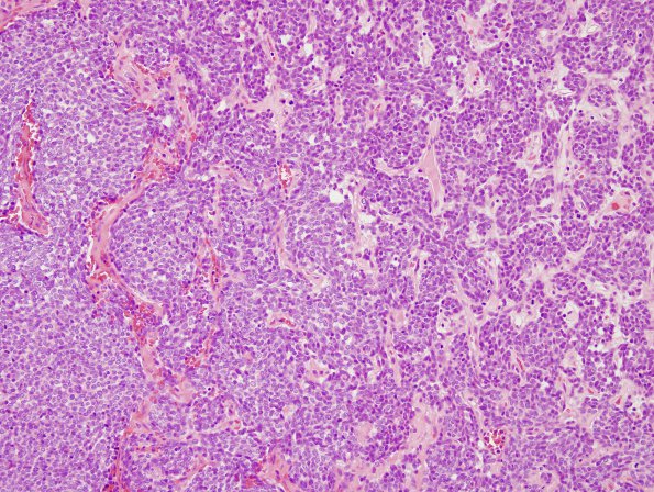 15H1 Hemangiopericytoma, Grade III (Case 15) H&E 2