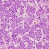 15H2 Hemangiopericytoma, Grade III (Case 15) H&E 3