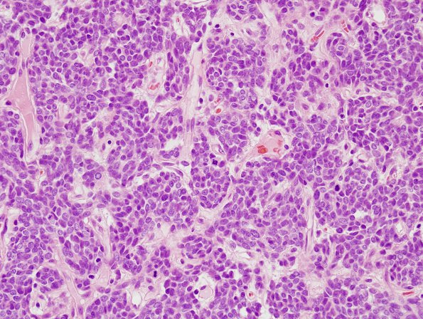 15H2 Hemangiopericytoma, Grade III (Case 15) H&E 3