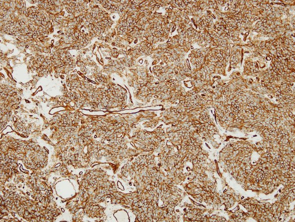 15I1 Hemangiopericytoma, Grade III (Case 15) CD34 1