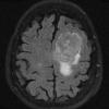 16A1 Hemangiopericytoma, Grade 3 (Case 16) T2 FLAIR - Copy