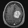 16A2 Hemangiopericytoma, Grade 3 (Case 16) T1 W 4 - Copy