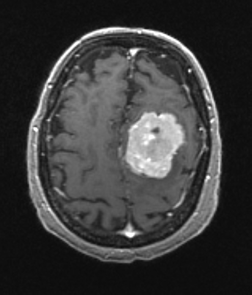 16A2 Hemangiopericytoma, Grade 3 (Case 16) T1 W 4 - Copy