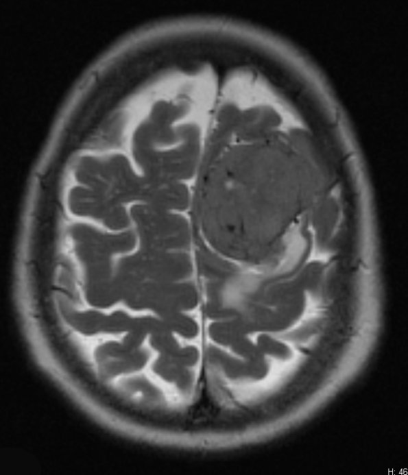 16A3 Hemangiopericytoma, Grade 3 (Case 16) T2 W 1 - Copy