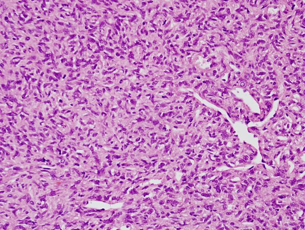 16C2 Hemangiopericytoma, Grade 3 (Case 16) H&E 1