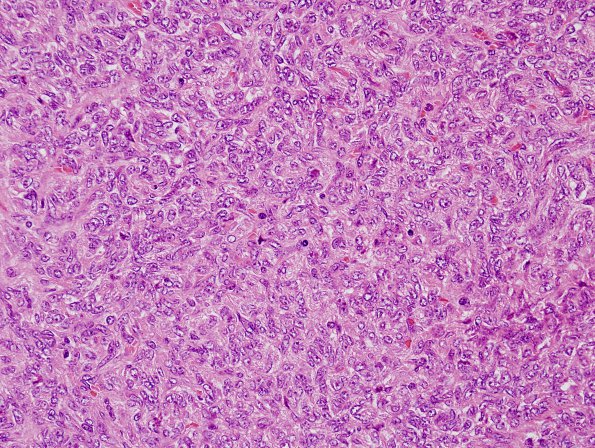 16C3 Hemangiopericytoma, Grade 3 (Case 16) H&E 5