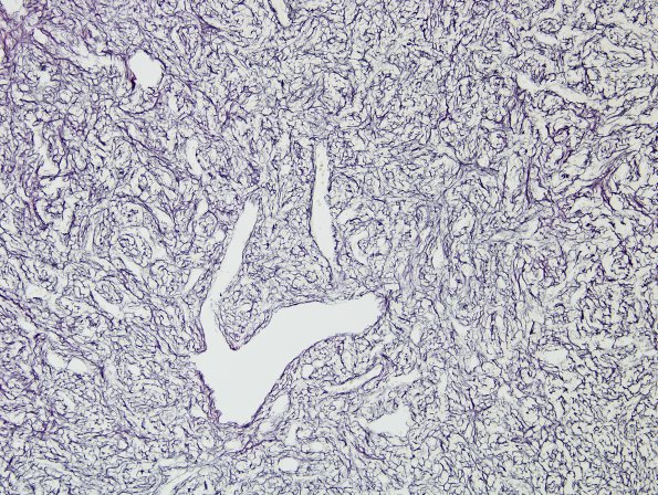 16D1 Hemangiopericytoma, Grade 3 (Case 16) Retic 6