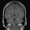 17A1 Solitary Fibrous Tumor (SFT, Case 17) T1 2 - Copy