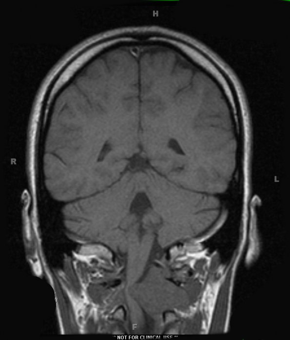 17A1 Solitary Fibrous Tumor (SFT, Case 17) T1 2 - Copy