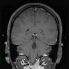 17A2 Solitary Fibrous Tumor (SFT, Case 17) T1 W 1 - Copy