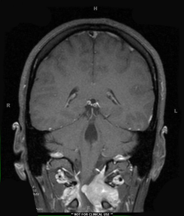 17A2 Solitary Fibrous Tumor (SFT, Case 17) T1 W 1 - Copy