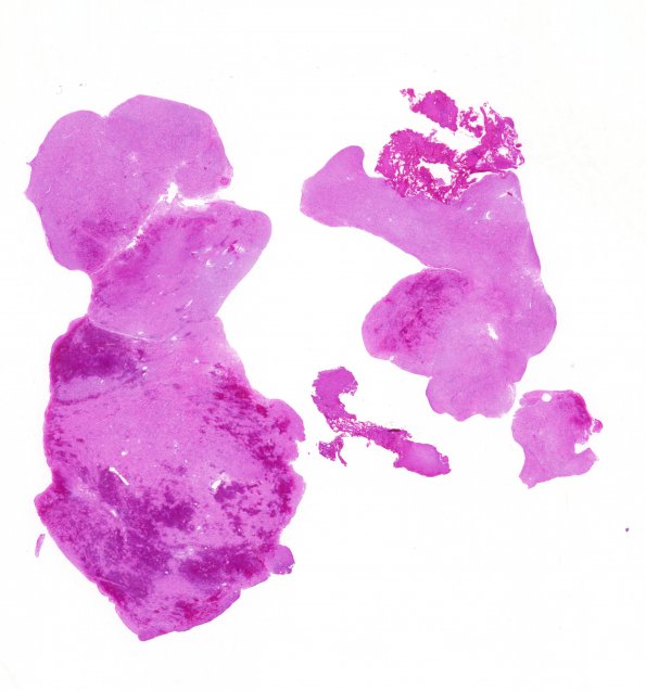 17B1 Solitary Fibrous Tumor (SFT, Case 17) 1 H&E WM