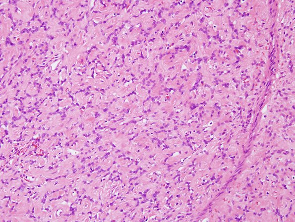 17B2 Solitary Fibrous Tumor (SFT, Case 17) H&E 6