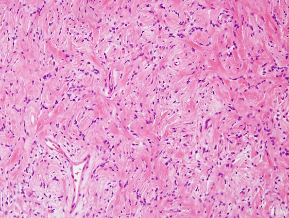 17B3 Solitary Fibrous Tumor (SFT, Case 17) H&E 10