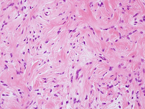 17B4 Solitary Fibrous Tumor (SFT, Case 17) H&E 7