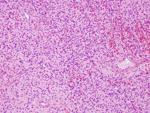 17B5 Solitary Fibrous Tumor (SFT, Case 17) H&E 4