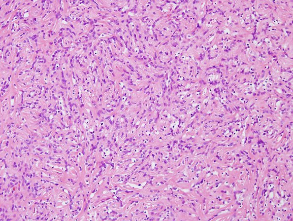 17B6 Solitary Fibrous Tumor (SFT, Case 17) H&E 3