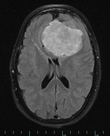 1A1 HAP-SFT, WHO 3 (Case 1) FLAIR 1 - Copy