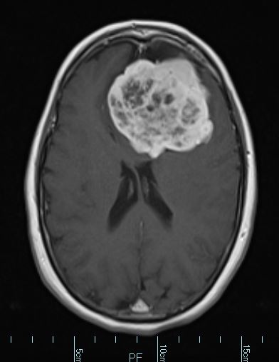 1A2 HAP-SFT, WHO 3 (Case 1) T1W - Copy