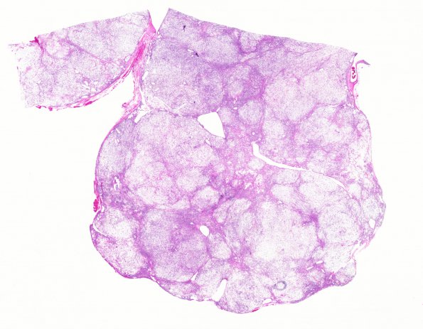 1B1 HAP-SFT, WHO 3 (Case 1) H&E WM