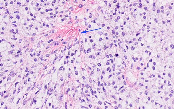 1B3 HAP-SFT, WHO 3 (Case 1) H&E 4 copy