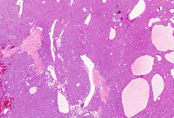 2A1 Hemangiopericytoma, anaplastic (WHO III, Case 2) H&E 4