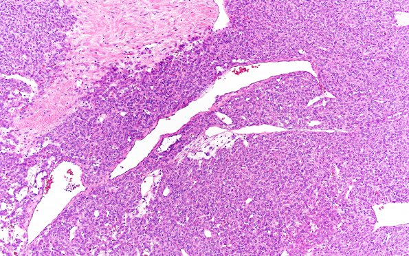 2A2 Hemangiopericytoma, anaplastic (WHO III, Case 2) H&E 3