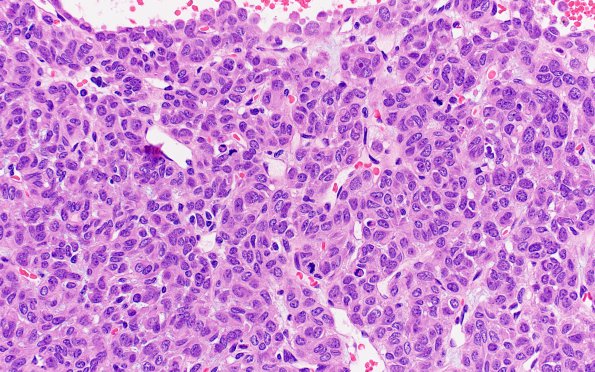 2A3 Hemangiopericytoma, anaplastic (WHO III, Case 2) H&E 2