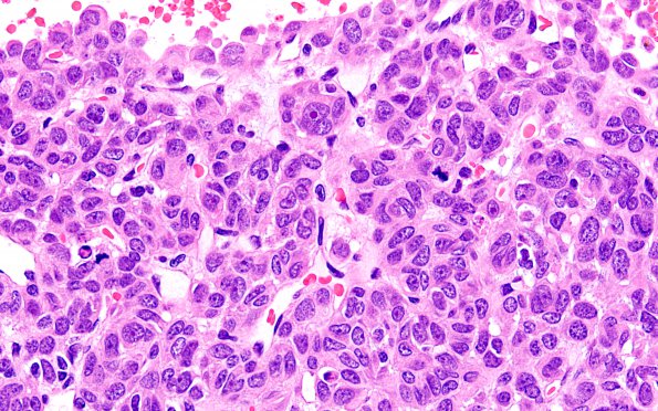 2A4 Hemangiopericytoma, anaplastic (WHO III, Case 2) H&E 1