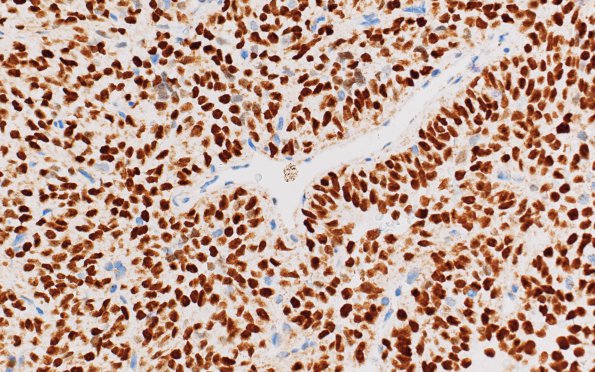 2C2 Hemangiopericytoma, anaplastic (WHO III, Case 2) STAT6 2