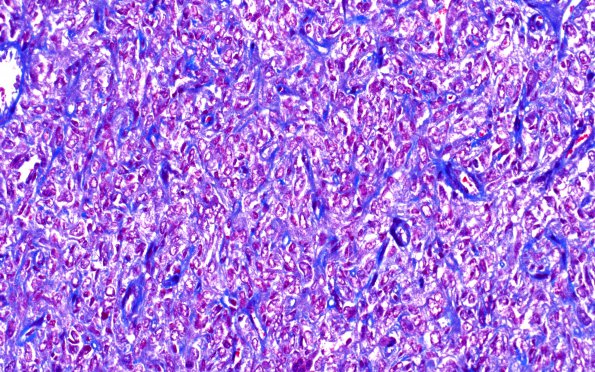 3B Hemangiopericytoma, WHO III (Case 3) Trichrome 1