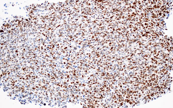 3D1 Hemangiopericytoma, WHO III (Case 3) STAT6