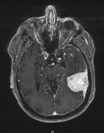 4A3 SFT (Case 4) T1W 1 - Copy