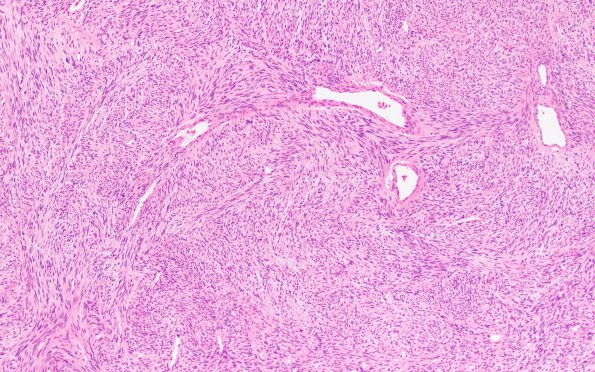 4B1 Solitary Fibrous Tumor (Case 4) H&E 10X