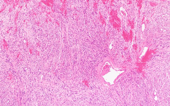 4B2 Solitary Fibrous Tumor (Case 4) H&E 10X 2