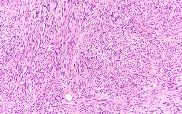 4B3 Solitary Fibrous Tumor (Case 4) H&E 20X