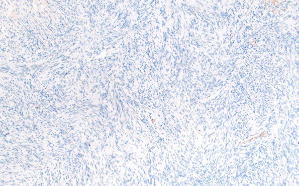 4C1 Solitary Fibrous Tumor (Case 4) EMA 10X