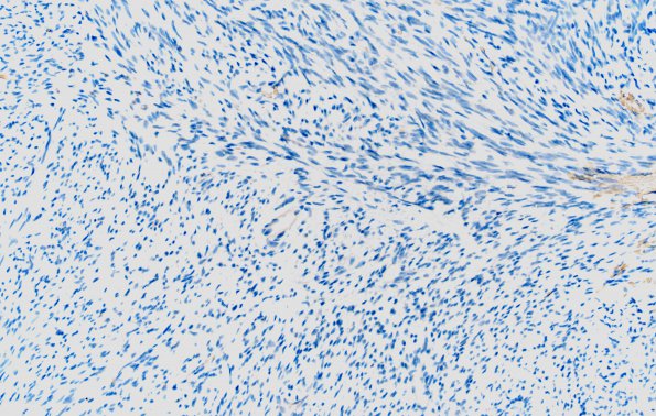 4C2 Solitary Fibrous Tumor (Case 4) EMA 20X